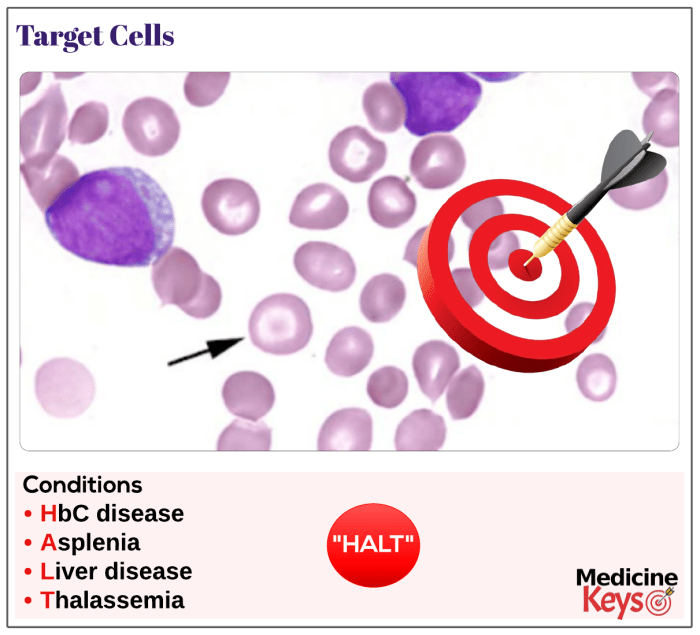 Target cells cell mexican hat rbc medicine blood academic ru thalassemia pathology similes metaphors part source